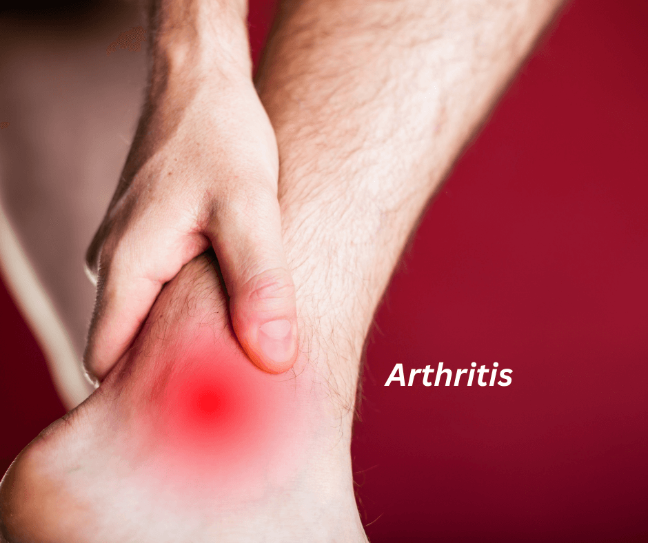 Arthritis