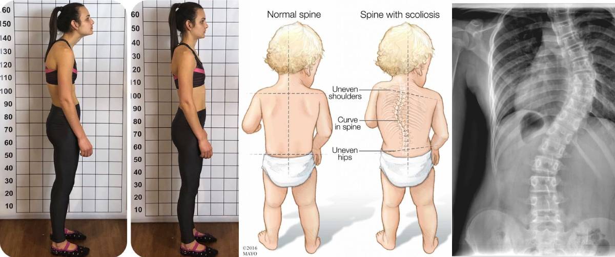 scoliosis