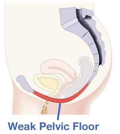 Weak Pelvic Floor