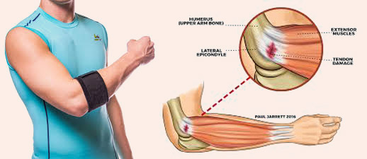 Könyökfásli Select Tennis elbow-caps fekete | AD alomoldal.hu