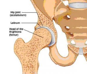 Hip Labral Tear | A+ Orthopaedics & Sports Med Center|New Delhi