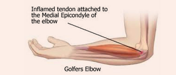 Golfer's Elbow | A+ Orthopaedics & Sports Med Center|New Delhi