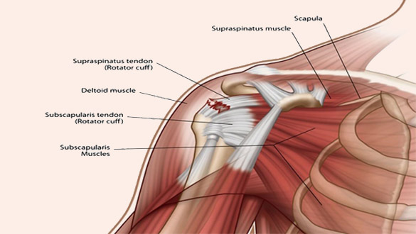 RC Tear Injury | A+ Orthopaedics & Sports Med Center|New Delhi