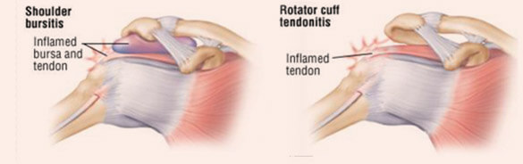 R C Tendinitis Impingement Syndrome A Orthopaedics Sports Med 