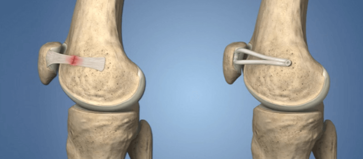 MPFL Services | A+ Orthopaedics & Sports Med Center|New Delhi